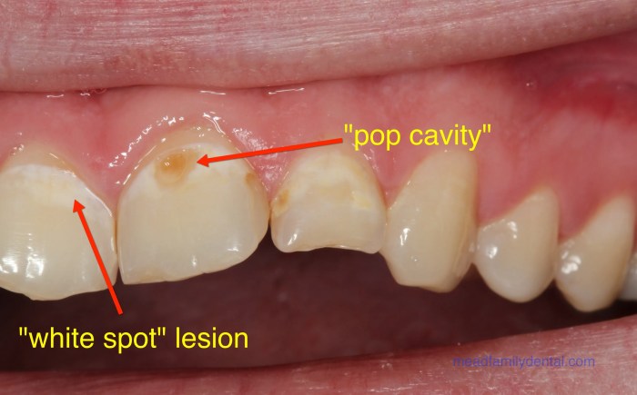 Natural find with a cavity crossword